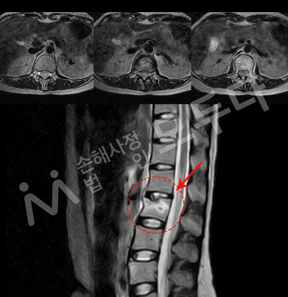 척추압박골절 MRI.png